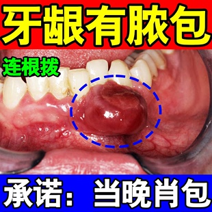 牙龈脓包肿包智齿消焱牙根周焱平鼓包流脓出血牙龈肿痛专用药 新品