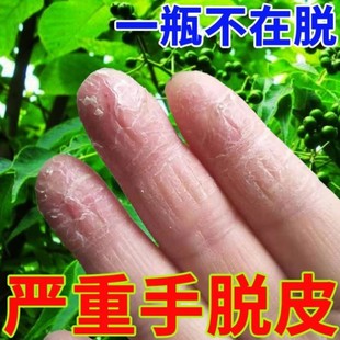 药膏真菌感染手指头手部鹅掌风干裂手癣修复汗疱疹膏 治疗手脱皮